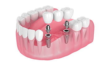 Multi Tooth Implants