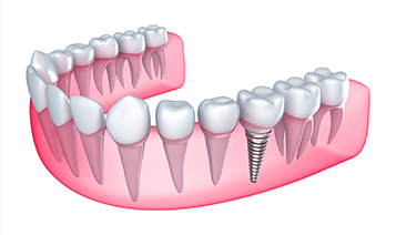 Single Tooth Implants